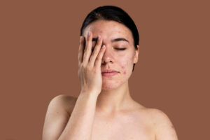 A photo of a woman with acne to show how to get rid of pimples